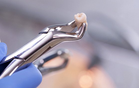 Forceps holding extracted tooth