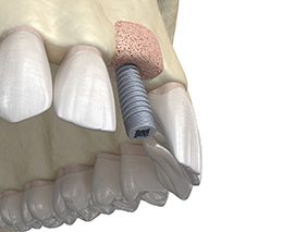 Digital illustration of bone graft in Broken Arrow