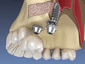 Digital illustration of sinus lift in Broken Arrow