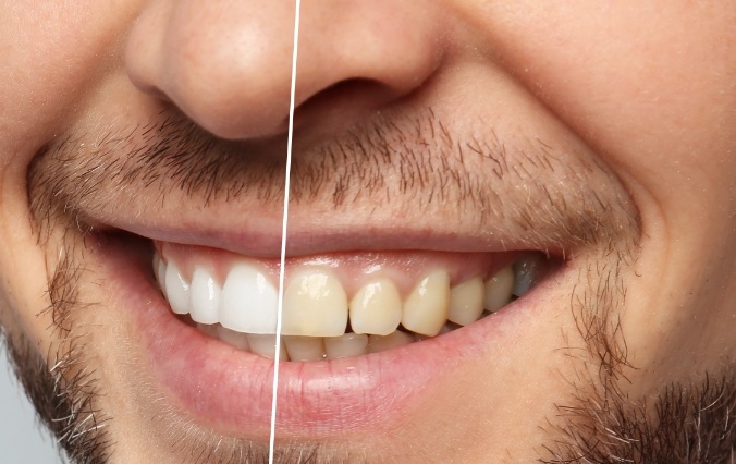 Smile before and after teeth whitening