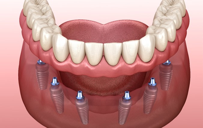 diagram of implant dentures in Broken Arrow
