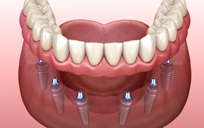 diagram of implant dentures in Broken Arrow 