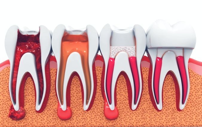 Animated tooth through the root canal therapy process