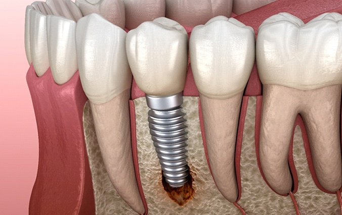 Failed dental implant in Broken Arrow