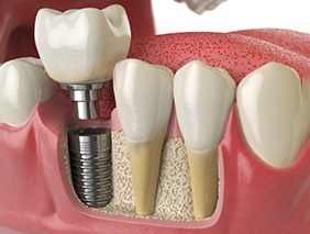 A 3D illustration of a dental implant placed in one’s jaw