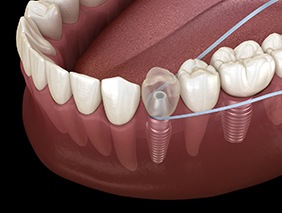 Digital illustration of flossing dental implant in Broken Arrow