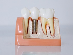 Model of a dental implant