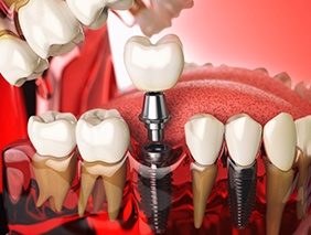 Model showing parts of a dental implant