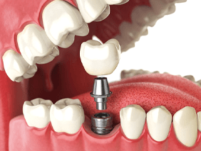 illustration for how dental implants work Broken Arrow