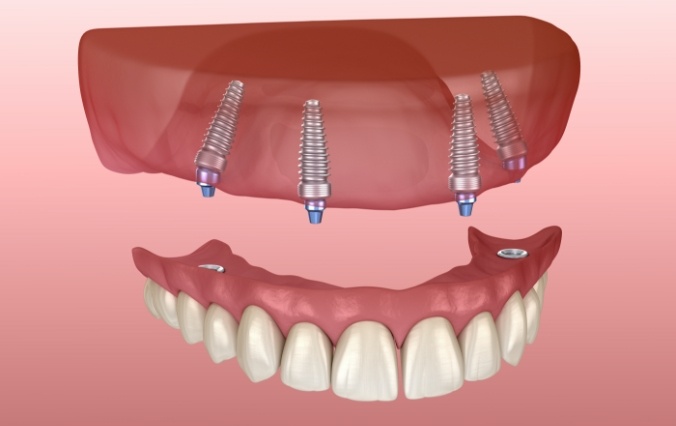 Animated smile with dental implant supported denture