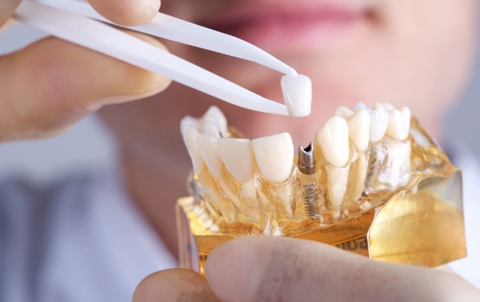 Model smile with dental implant supported dental crown