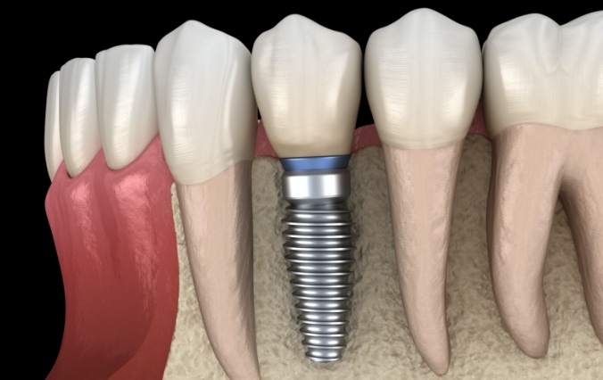 Animated smile with dental implant placed into bone graft