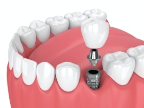 Animated smile with dental implant supported dental crown