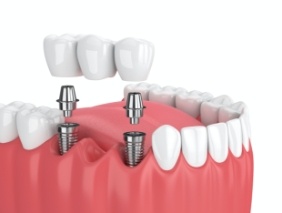 Animated smile with dental implant supported fixed bridge