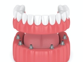 Animated smile during dental implant supported denture placement