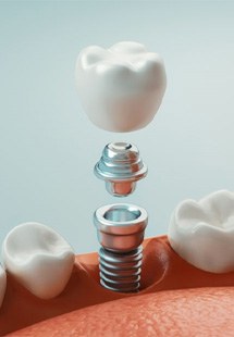 a 3 D example of a dental implant