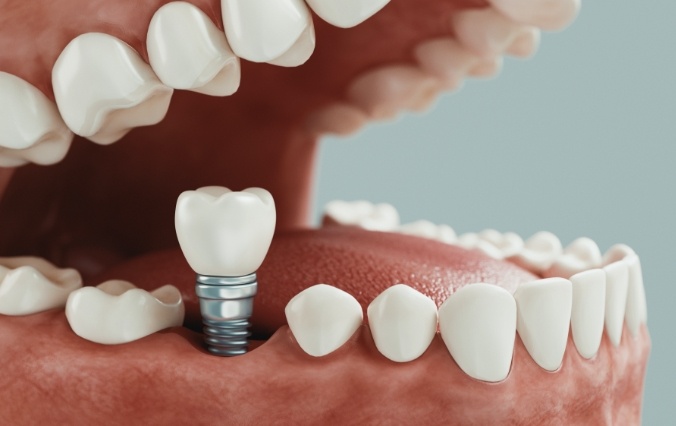 Animated smile during dental implant supported dental crown