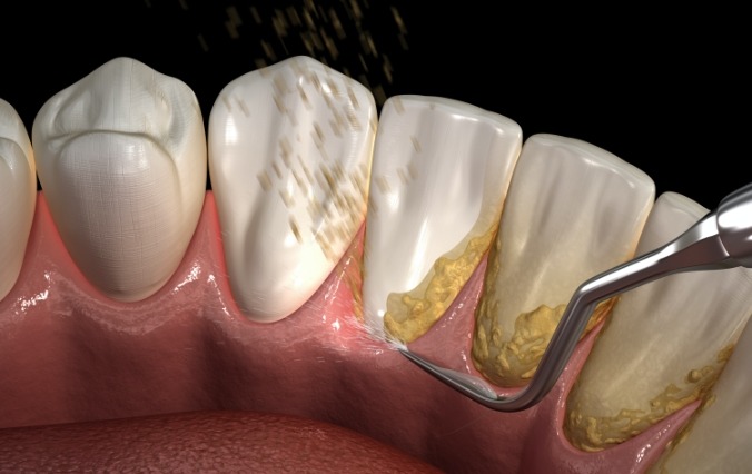 Animated smile during scaling and root planing treatment