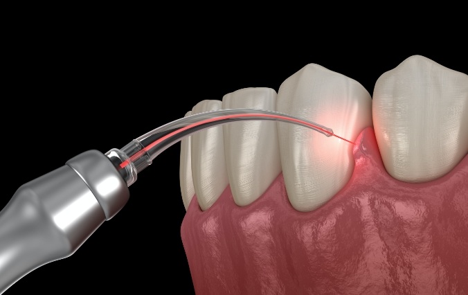 Animated smile during laser treatment