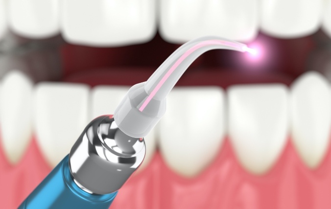 Dental laser and smile