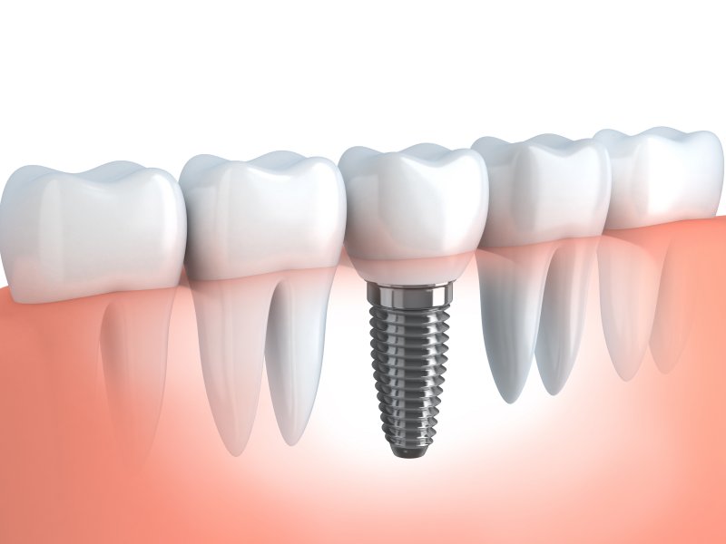 Single dental implant in the lower arch of teeth