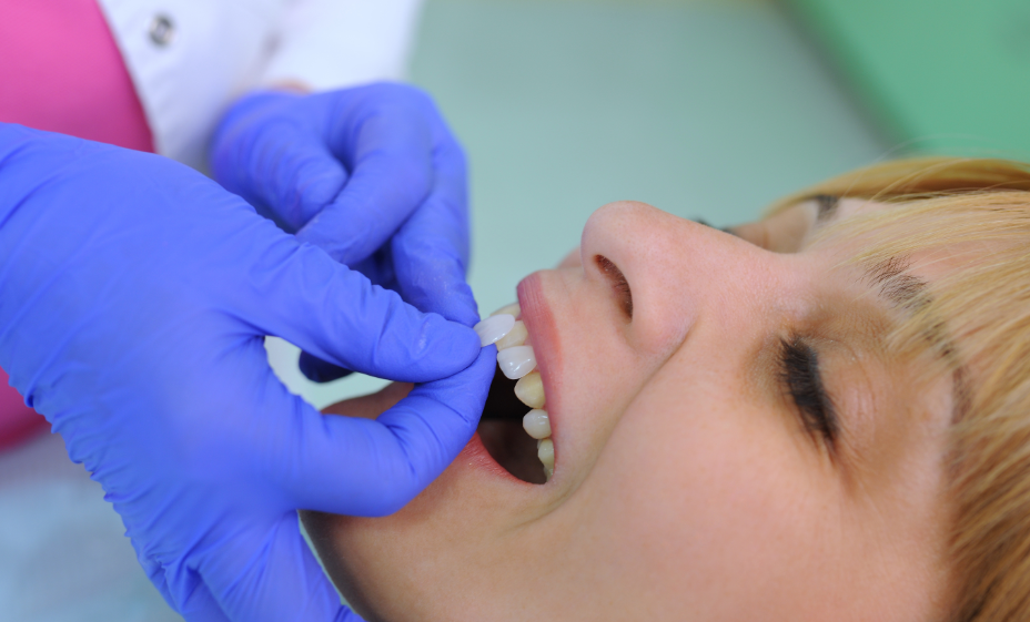 Patient getting veneers placed